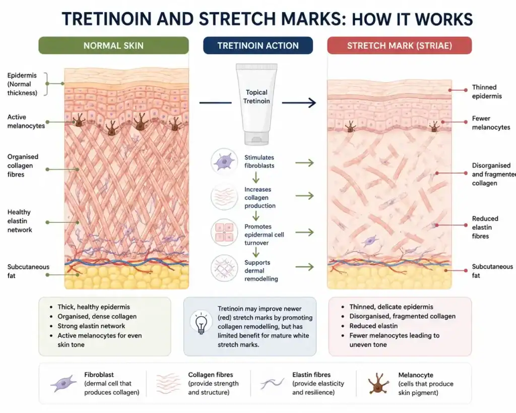 Normal dermis vs stretch mark dermis diagram with tretinoin mechanisms